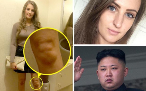 &#91;KOMUK NEWS&#93; Aneh, Lutut Gadis Ini Berbentuk Wajah Kim Jong-un
