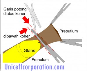 MENGENAL 7 METODE SUNAT/KHITAN (SIRKUMSISI) ( with Pic &amp; Tips )