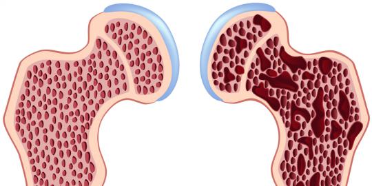 15-makanan-pelawan-osteoporosis