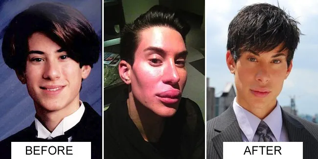 Pria Operasi Plastik Agar Mirip Pacar Barbie+Pic