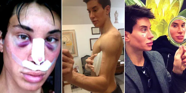 Pria Operasi Plastik Agar Mirip Pacar Barbie+Pic