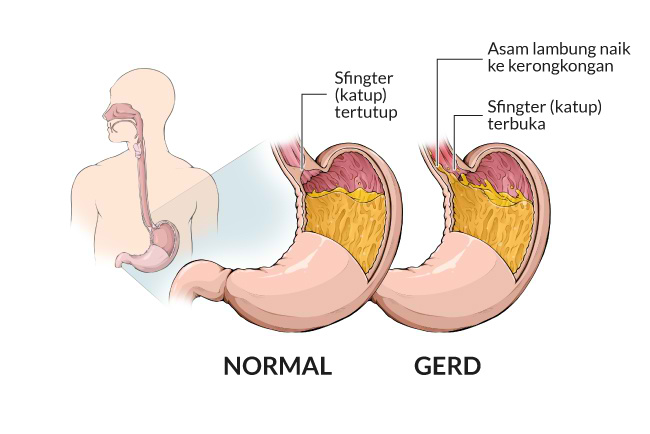 Jangan Sepelekan Maag: Kenali Gejala, Bahaya, & Cara Mencegahnya
