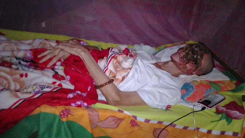 Seorang Pria di Vietnam Yang Punya Penyakit Langka, Ngeri Gan