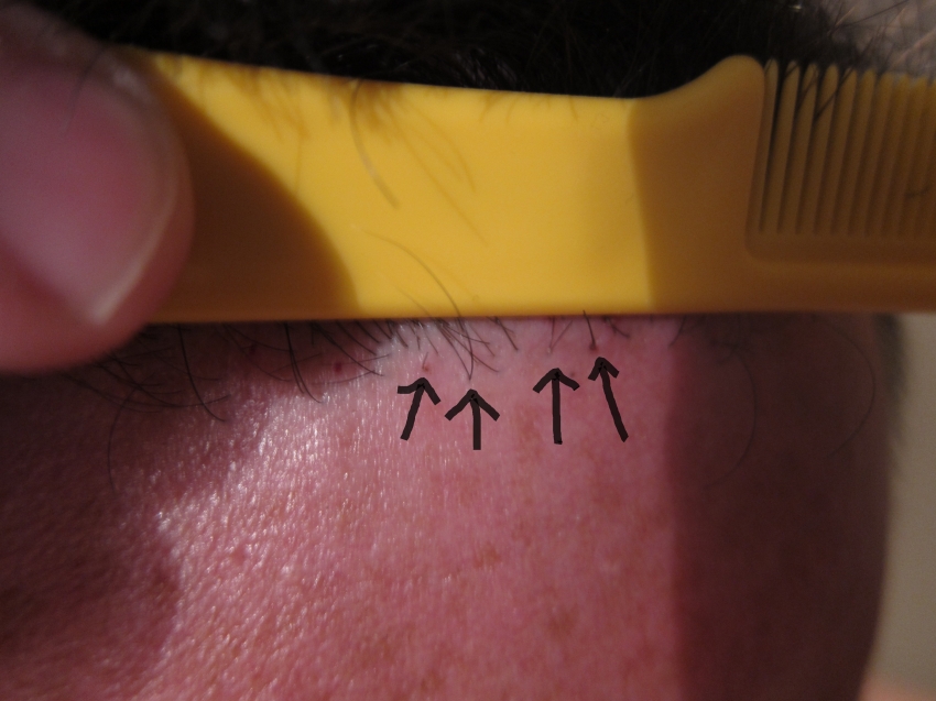 CARA CANGKOK RAMBUT / HAIR TRANSPLANT SENDIRI!! (ASAL LU BERANI)