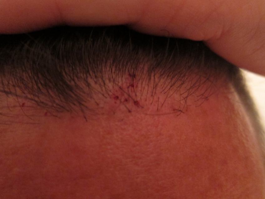 CARA CANGKOK RAMBUT / HAIR TRANSPLANT SENDIRI!! (ASAL LU BERANI)