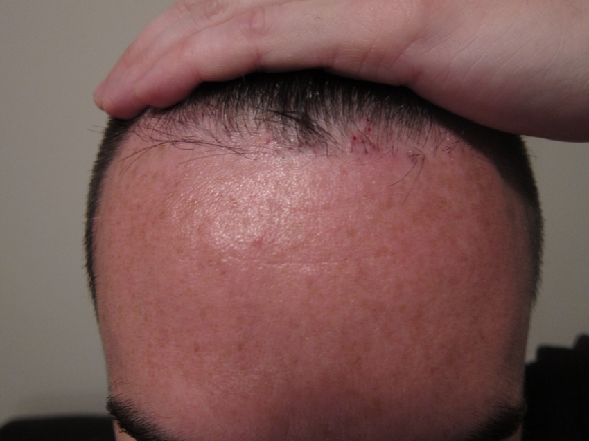 CARA CANGKOK RAMBUT / HAIR TRANSPLANT SENDIRI!! (ASAL LU BERANI)