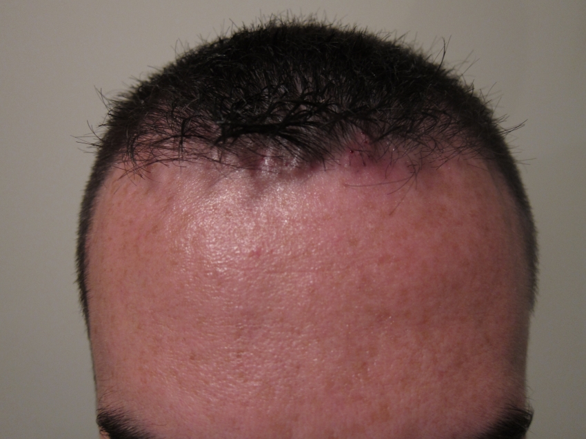 CARA CANGKOK RAMBUT / HAIR TRANSPLANT SENDIRI!! (ASAL LU BERANI)