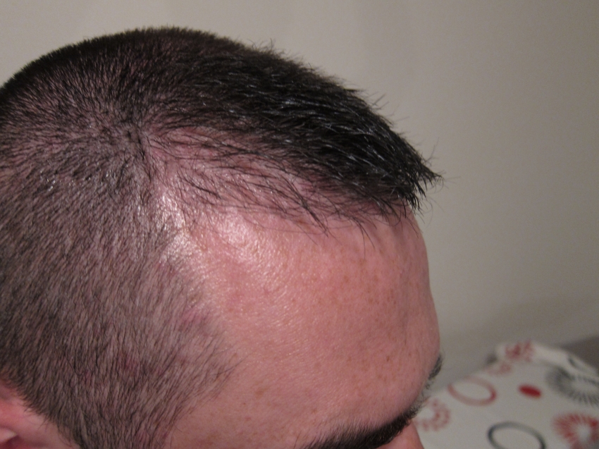 CARA CANGKOK RAMBUT / HAIR TRANSPLANT SENDIRI!! (ASAL LU BERANI)
