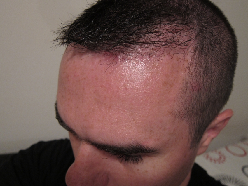 CARA CANGKOK RAMBUT / HAIR TRANSPLANT SENDIRI!! (ASAL LU BERANI)