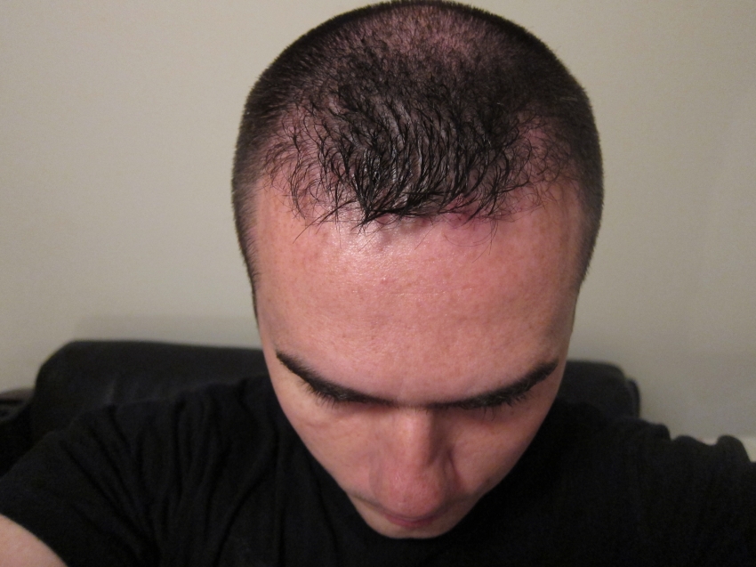 CARA CANGKOK RAMBUT / HAIR TRANSPLANT SENDIRI!! (ASAL LU BERANI)