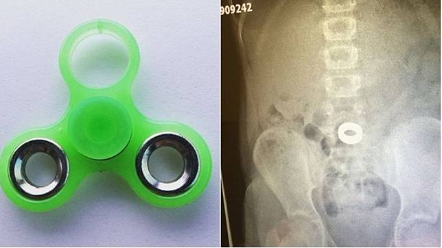 Anak Kecil Telan Fidget Spinner, Ini Foto X-Ray Mainan di Perutnya