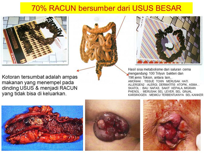 Fiforlif Detox Obat Turun Kolesterol