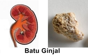 Waspada batu ginjal bagi kesehatan anda!
