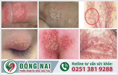 Phân biệt mụn rộp sinh dục và sùi mào gà bằng những dấu hiệu nào?