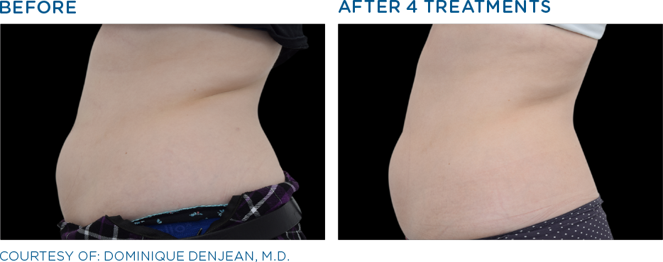 Klinik kecantikan slimming treatment semarang | Slimming treatment di semarang