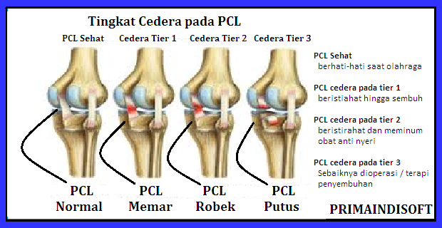 Cedera yang Biasa Menimpa para Atlet