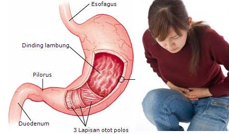 Sering Mengkonsumsi Makanan Pedas? Hati-hati Terkena Penyakit ini!