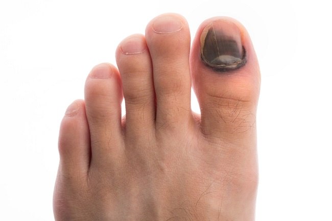 Warna Kuku Jari Kaki Bisa Jadi Pertanda Penyakit Gan!