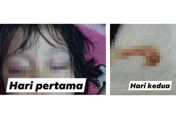 Mata Gadis Ini Mengeluarkan Nanah, Diduga Radiasi Dari HP, Bagaimana Pendapat Dokter?