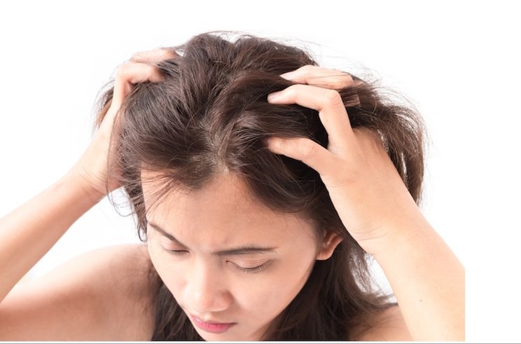 9 Cara Menghilangkan Ketombe yang Ampuh Menggunakan Bahan Alami