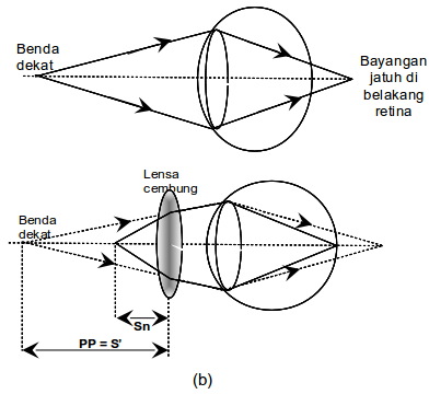 Mengenal Kelainan Penyakit Pada Mata Kaskus Archive