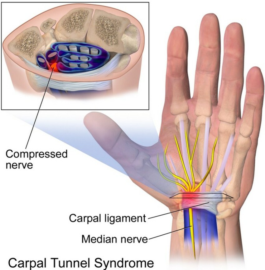 Kenali 5 Gejala CTS: Penyakit yang Menyerang &quot;Keyboard Warrior&quot;