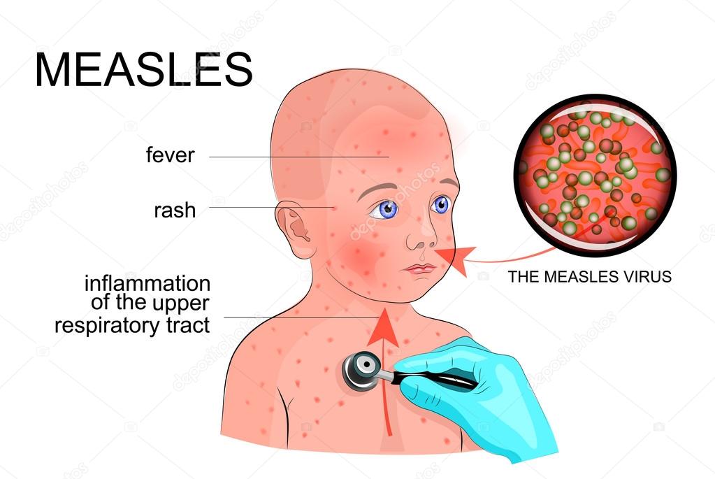 Warga di Sidrap Dihimbau Tidak Ikut Imunisasi Campak-Rubella