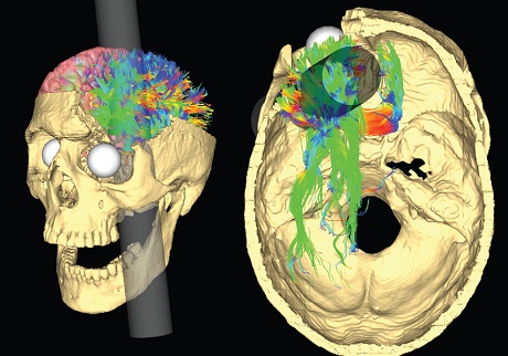 Kasus Phineas Gage: Berubahnya Sifat Akibat Sebatang Besi Besar Menembus Tengkorak