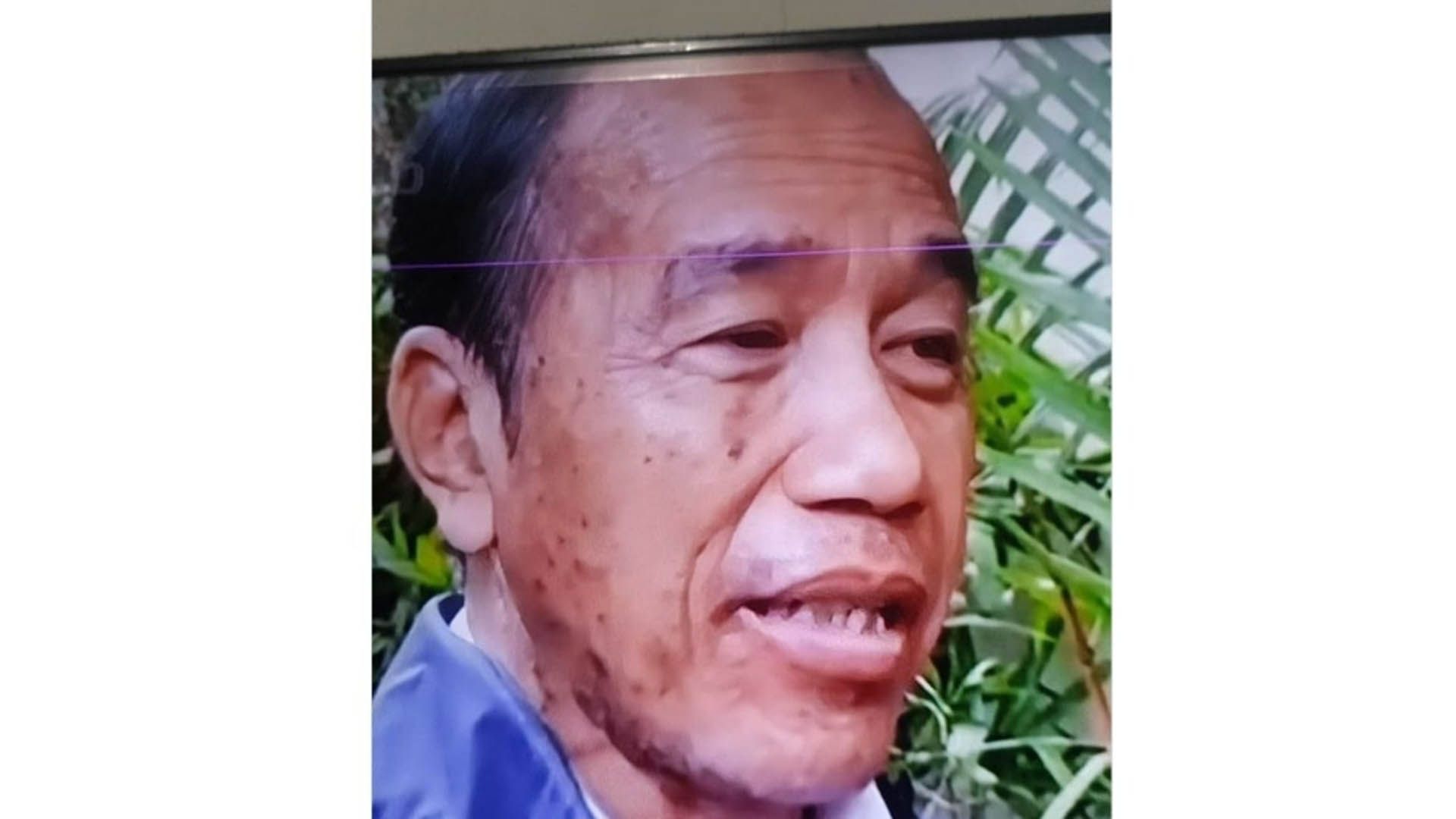 Ada Apa dengan Kulit Jokowi? Warganet Soroti Perubahan & Dugaan Alami Stress