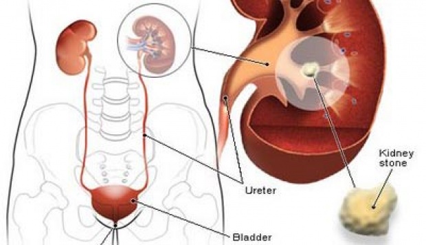 10 Kelainan Pada Ginjal Yang Berbahaya