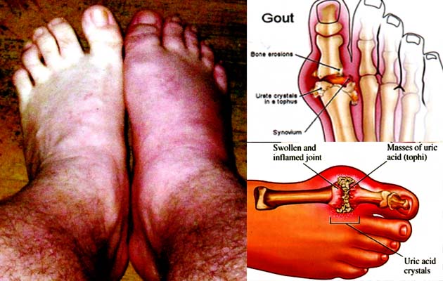 ati-ati gan,cantengan bisa bikin kaki agan di amputasi