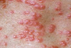 Cara Mengobati Scabies (Gudik) gudiken