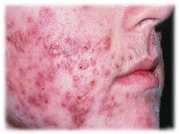 Waspadai Demodex, Parasit Perusak Kulit (Must see)