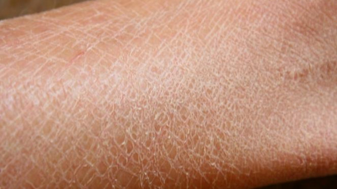 3 Penyebab Gatal Saat Olahraga