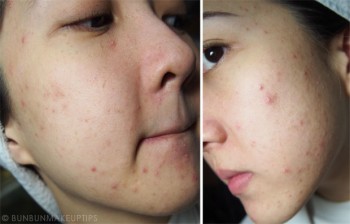 Wajah Mulus Blogger Cantik ini Rusak Parah Setelah Facial Gratis