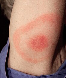 Mengenal Penyakit Lyme ( Lyme Disease ) yang diderita Avril Lavigne