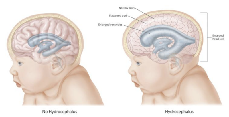 Dandy Walker Syndrome, Penyakit Sporadis yang Mengambil Adam Fabumi