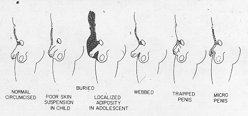 Gan…punya saya bisa diperbesar atau diperpanjang gak ya? (Small Penis Syndrome)