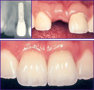 Sedikit Gambaran sebelum Memutuskan Memakai Dental Implant (GIGI TANAM) 