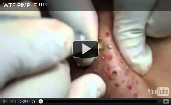 Video Seru: Dokter menangani komedo parah. &#91;Yg gelian jgn masuk!&#93;